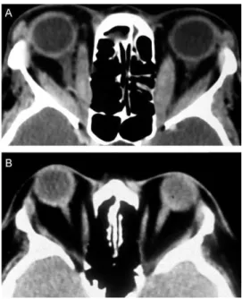 Figure 1 - Coronal CT scans from two patients with Graves’
