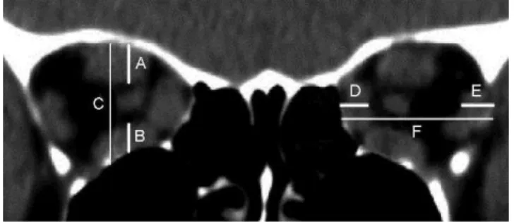 Figure 6 - Coronal CT scan showing orbits with apical crowding due to enlarged extraocular muscles