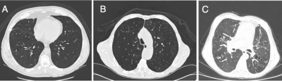 Figure 1 - Tomographic cross-sections. A) Asthmatic patient with diffuse bronchial wall thickening