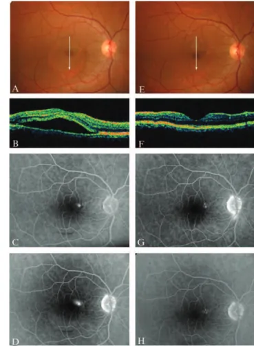 Figure 3 - A patient with a six-month history of CSC and macular serous detachment (A-B)