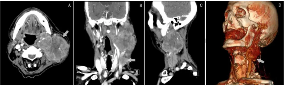 FIGURE 2: Cervical CT-scan on readmission, revealing incarceration of the left carotid sinus