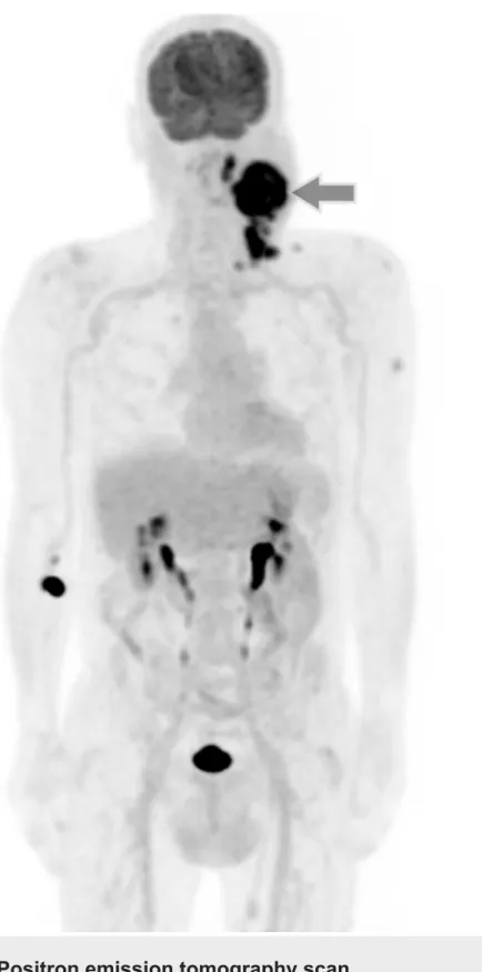 FIGURE 3: Positron emission tomography scan