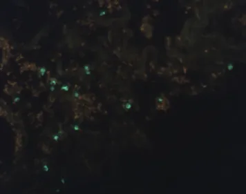 Figure 2 - Apoptotic cells photographed under a fluorescence microscope at high magnification (x400).