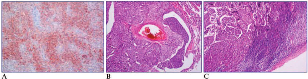 Figure 3 - A) ACTH staining of bronchial cells. B) Vascular invasion by tumor cells. C) Lymphoid invasion by tumor cells.