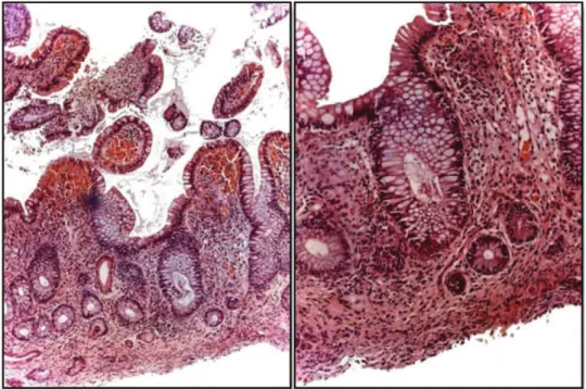 Figure 2 - Mucosal atrophy, where villous: crypt ratio is 1:1. Enlargement of the villi, Lymphocytic predominance and lamina propria’s fibroplasia.