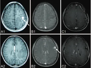 Figure 1 - A series of pre-operational MR images demonstrates the local migration of an irregular, enhanced lesion (arrow) in the left hemisphere (A1-A2) six months before the operation;