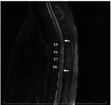 Figure 2 - Magnetic resonance imaging of the thoracic spine. Sagittal T2-weighted imaging reveals a hyperintense posterior mass extending from T5-T6 to T7-T8 (white arrows), which compresses the spinal cord anteriorly.