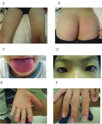 Figure 2 - Symptoms during treatment. Maculopapular skin rash with pruritus distributed over the buttocks and lower extremities was apparent 7 days after fever onset (A, B)