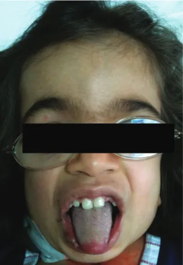 Figure 2 - Coarse face - one of the confirmatory feature of Maroteaux-Lamy syndrome.