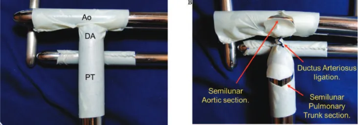 Figure 3 - A) The pulmonary trunk (PT) was represented using an 18-mm pericardial tunnel