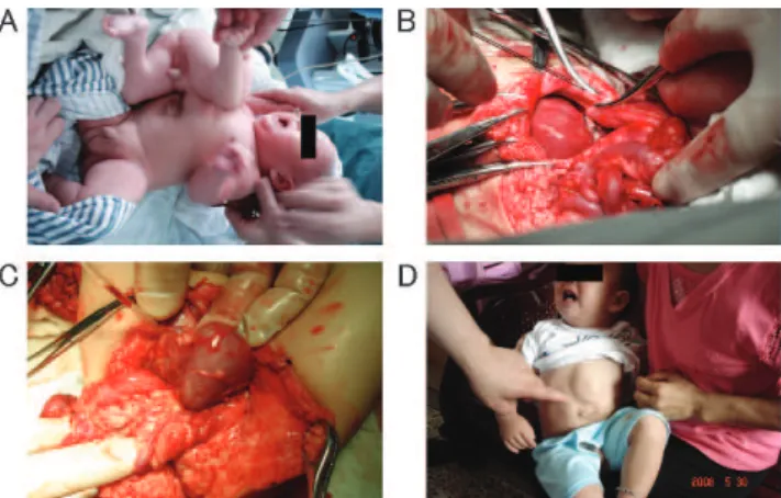 Figure 1 - (A) The parasitic twin in case 1 had a fully developed pelvis, two pairs of limbs, and a well-developed penis, which produced urine discharge