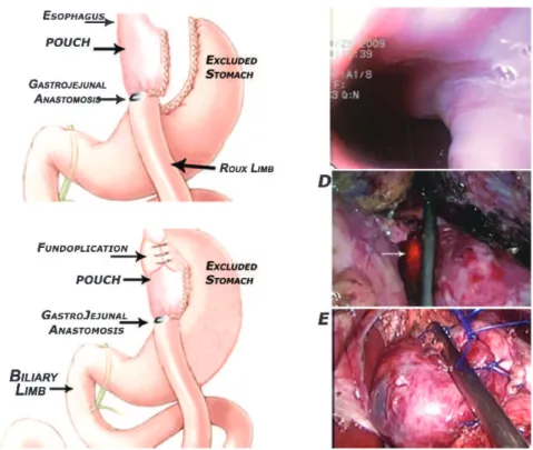 Figure 2 - Pre - and intraoperative endoscopic view during laparoscopic fundoplication post-RYGB for obesity
