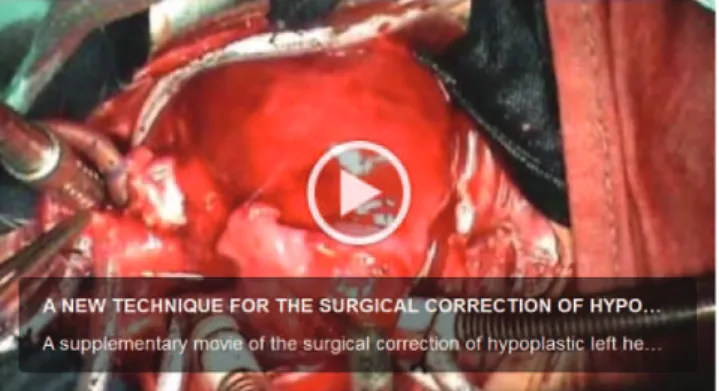 Figure 5 - A supplementary movie 1 of the surgical correction of hypoplastic left heart syndrome (stage 1) performed with the new proposed technique