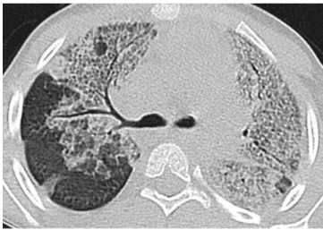 Figure 4 - A 7-year-old boy with respiratory failure and with a confirmed diagnosis of H1N1