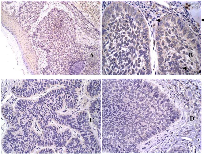 Figura 2 – Imunolocalização dos antígenos: A - MMP-2; B - MMP-9; C - TIMP-1 e D - TIMP-2 em carcinoma basocelular