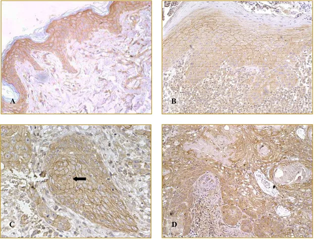 Figura 1 - Expressão de MMP-2 - Foi identificada no citoplasma e na membrana celular dos queratinócitos da pele normal (A) e da epiderme adjacente ao tumor(B) e nas células neoplásicas (B e C)