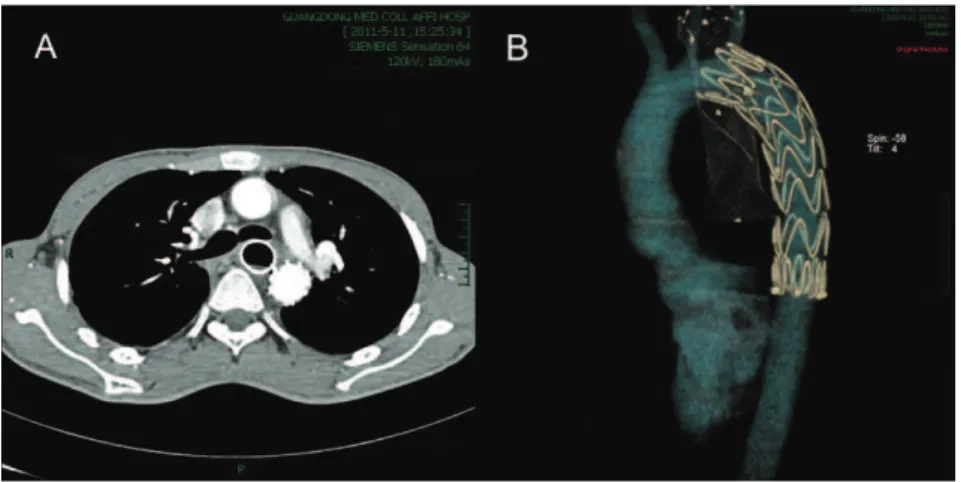 Figure 3A and B - CT angiography confirmed successful tamponade of the fistula.