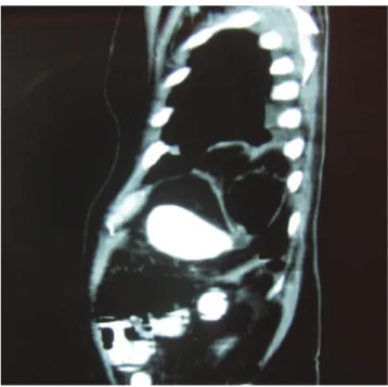 Figure 3 - The view of the diaphragmatic defect after the bowel segment was reduced.