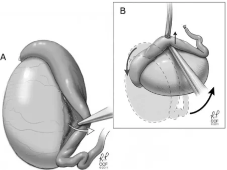 Figure 6 - Mobilization of the epididymis. A) Division of the tunica albuginea through the avascular potions of the lateral epididymal sulcus allows posterior rotation of the epididymal body