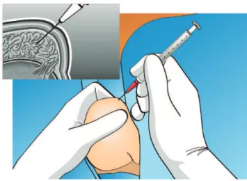 illustration depicts TESE using a single open biopsy (see the text for a detailed description)