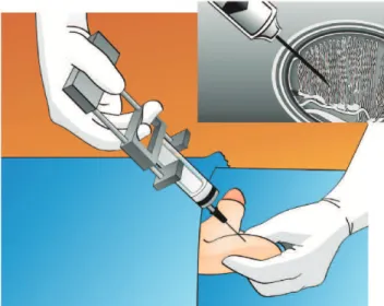 Figure 5 - Testicular fine-needle aspiration (TEFNA). A 23-gauge fine needle attached to a 10-mL syringe coupled to a Cameco syringe holder is percutaneously inserted into the testicle to map different areas