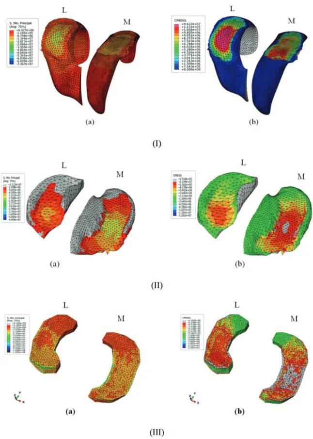 Figure 4 - I) Maximum stress on the femoral cartilage and b) the contact pressure on the femoral cartilage; II) a) the maximum stress on the tibial cartilage and b) the contact pressure on the tibial cartilage; III) a) the maximum stress on the meniscus an