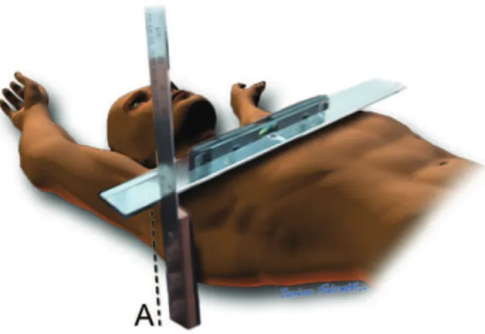 Figure 2 - Measurement B) The lowest depth of the defect, using the highest point of the anterior chest wall and the deepest point of the pre-sternum region at the DT as reference points.