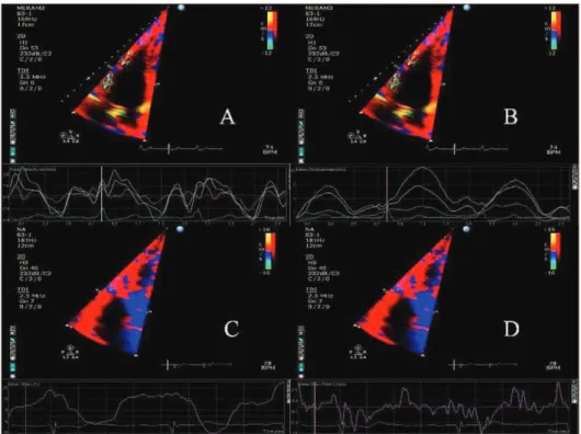 Figure 1 - A) Myocardial velocities associated with the basal, mid, and apical segments of the right ventricle