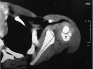 Figure 2 - Three years after the operation. Humeral head centered in the glenoid cavity and reduction of the glenoid retroversion (left shoulder).