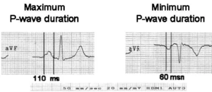 Figure 1 - The P-wave durations (Pmax and Pmin) were calculated in all 12 ECG leads.