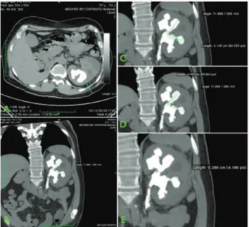 Figure 1 - A) Distance A – the distance between the skin and kidney at the angle of percutaneous access