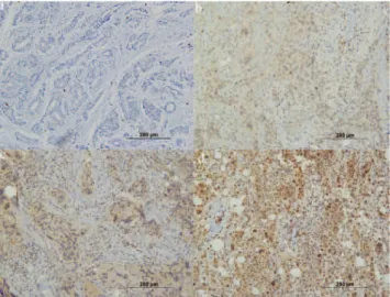 Figure 2 - HIF2A in breast carcinoma. Note the progressive (0, 1+, 2 + , and 3 + ) expression in invasive carcinoma