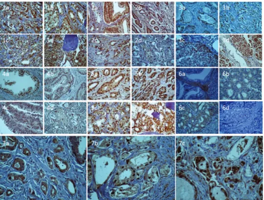 Figure 2 - Expression of miR-let7c, miR-100 and miR-218 in 60 cases of localized prostate cancer as part of a TMA to evaluate the protein immunoexpression of their supposed target genes.