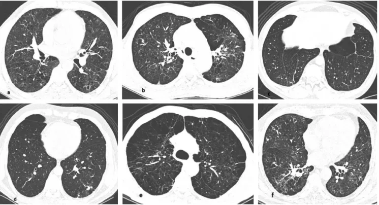 Figure 2 - Figure showing that emphysema quantification by CT was significantly higher in the most severely impaired PCM patients compared to the least severely impaired PCM patients.