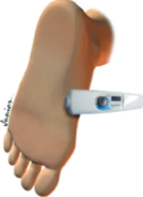 Table 4 displays the changes in the amount of sweat for each foot according to the resection level (T3 and T4) at one week, one month, six months, and one year after the operation.