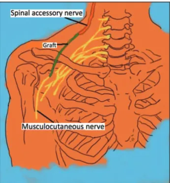 Figure 5 - Spinal accessory nerve to musculocutaneous nerve.
