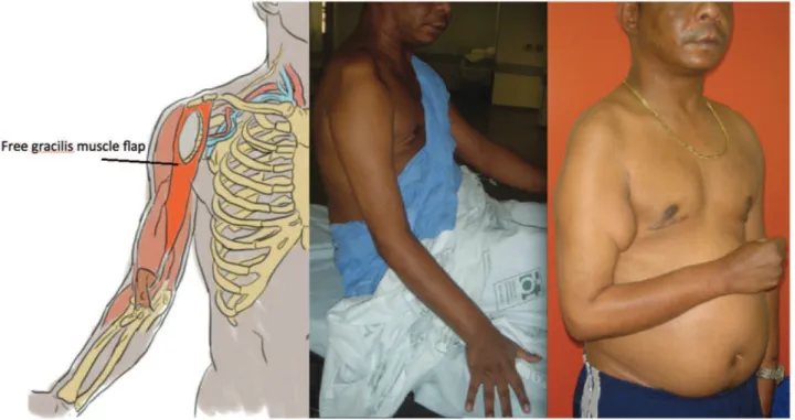Figure 6 - Free muscle transfer (gracilis to biceps): pre- and postoperative results. Note deficit of elbow flexion and satisfactory elbow function afterwards.