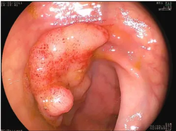 Figure 1 - Rectal lesion. Pre-procedure aspect.