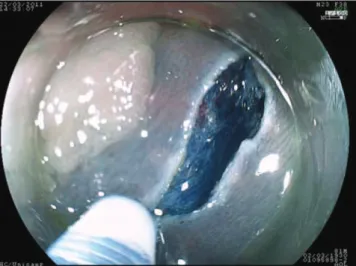 Figure 2 - Initial submucosal dissection after injection with indigo carmin.