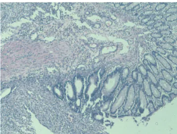 Figure 4 - The histopathologic appearance of grade 4 inflamma- inflamma-tory cell infiltration in the Control Group (hematoxylin and eosin staining visualized under light microscopy, 40x).