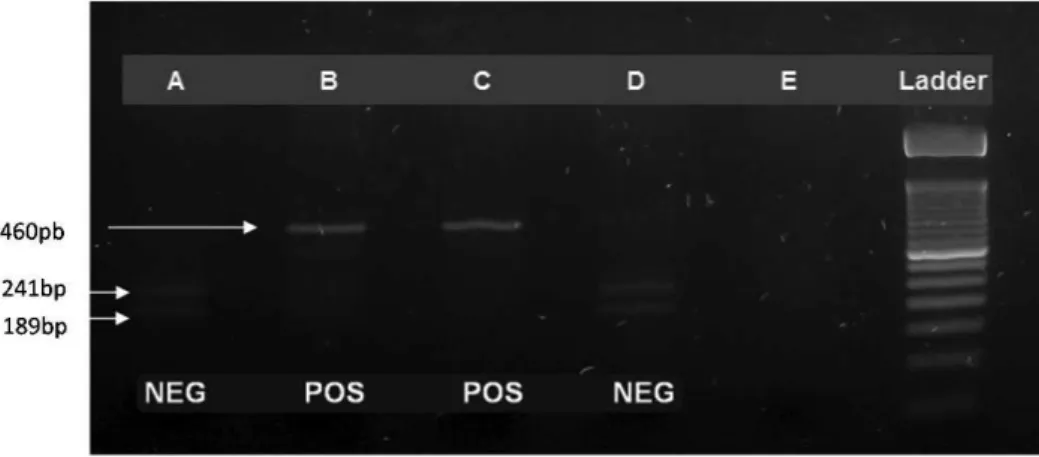 Figure 2 - JAK2 rs10974944 SNP allele screening using the PCR-RFLP technique. The presence of the G allele is characterized by the observation of a 213-bp band, whereas the presence of the C allele is noted by the observation of a 176-bp band, relative to 