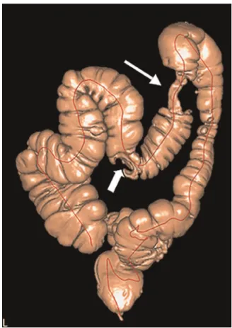 Figure 1 - CTC volume rendering showing a synchronous tumor of the transverse colon (large arrow)
