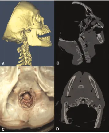 Figure 2 - A diagram showing the creation of simulative atlantoaxial dislocation. A Lateral view of the cadaver (CT reconstruction) after the creation of simulative dislocation; B Lateral-viewed CT scan; C Top view from the transcranial approach; D Axial-v