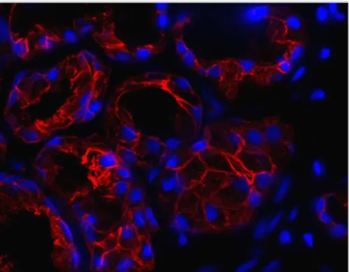 FIGURA 3 – Imunofluorescência para Citoqueratina AE1/AE3 para evidenciar a   natureza epitelial das células da amostra anterior (Citoqueratina em vermelho   e núcleos contracorados com DAPI em azul)