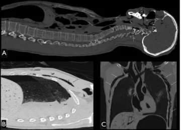 Figure 2 - PMCT images, multiplanar reconstruction axial (A and B) and coronal (C) pulmonary window