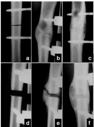 Figure 1 - Radiographic controls for both the linear (above) and resection (below) osteotomies, showing the callus evolution with postoperative time (a and d: immediately afterwards; b and e: 60 days; c and f: 90 days).