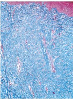 Figure 3 - The histology of hypertrophic scars is characterized by replacement of the papillary and reticular dermis by scar tissue with prominent vertically oriented blood vessels