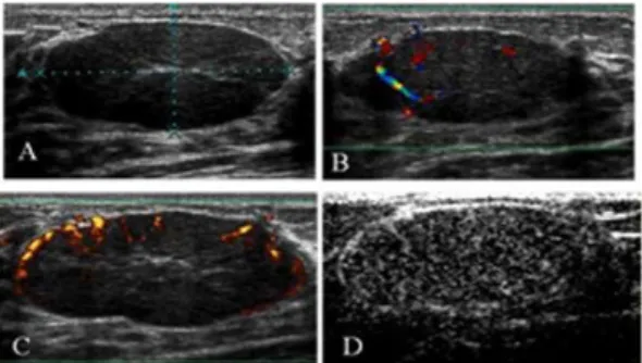Table 2 - Final breast lesion assessment using gray-scale US, unenhanced CDUS, and enhanced CDUS.