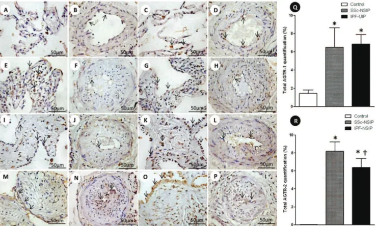 Figure 1 - Cellular expression of the angiotensin II type 1 receptor (AGTR-1) and AGTR-2 divided in septal areas and intrapulmonary vessels from normal control lungs, systemic sclerosis (SSc) and idiopathic pulmonary fibrosis (IPF)