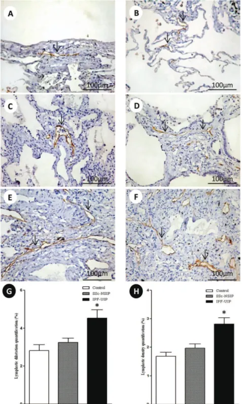 Figure 2 - D2-40 cell expression in the lymphatic vessels of the normal control lungs, systemic sclerosis (SSc) and idiopathic pulmonary fibrosis (IPF)